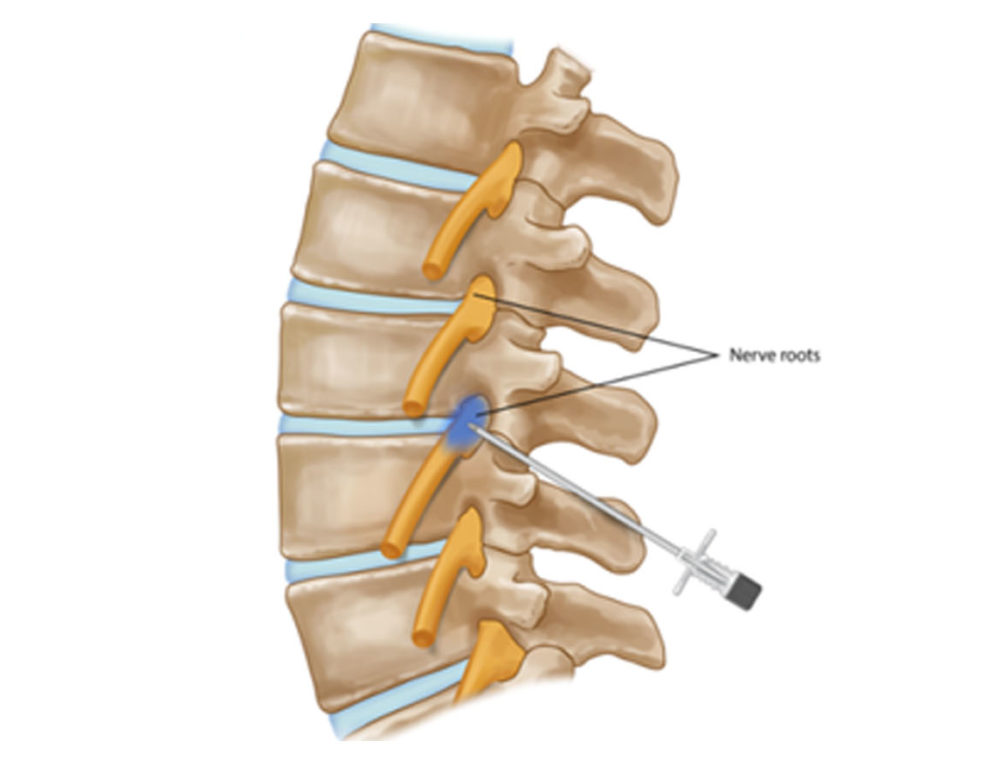 Degenera O Do Disco Intervertebral Qual A Diferen A Entre Protrus O E H Rnia De Disco Dr