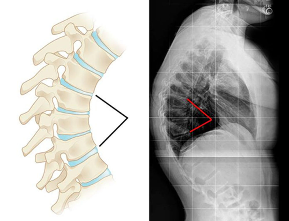 Degenera O Do Disco Intervertebral Qual A Diferen A Entre Protrus O E H Rnia De Disco Dr